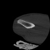 SPORK, NICO - 22.03.1976 - 02.08.2022 - CT obere Extremität - 17:51:17